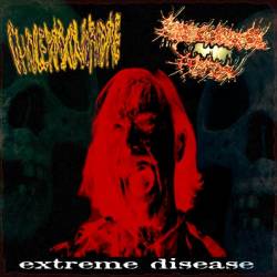 Erythrioblastosis Fetalis : Extreme Disease